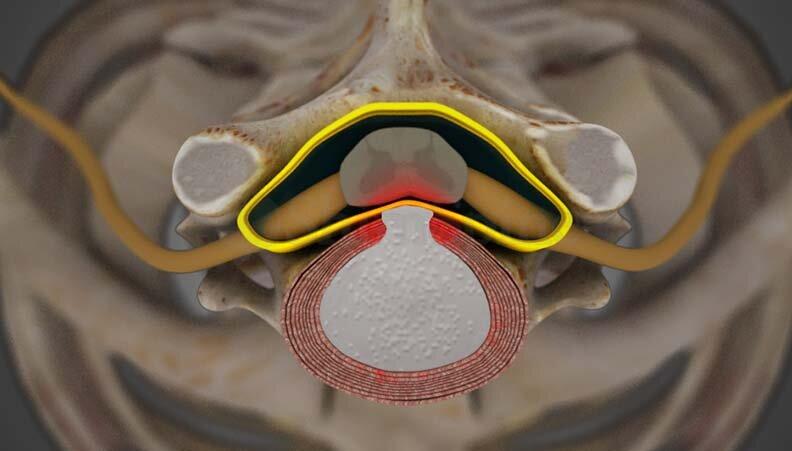 Understanding Lumbar Myelopathy: Causes, Symptoms, and Treatment