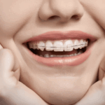 Clear Aligners