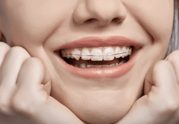 Clear Aligners