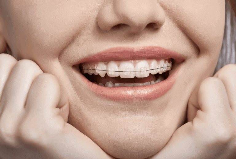 Clear Aligners