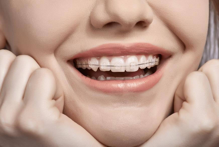 Clear Aligners